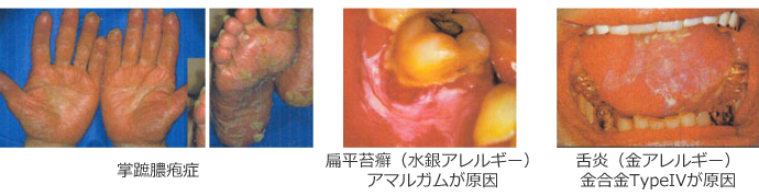 金属アレルギーと歯科金属アレルギー