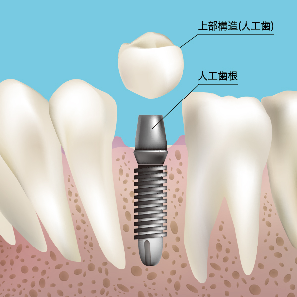 インプラント構造