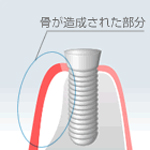 GBR(骨誘導再生)