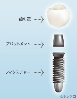 インプラント