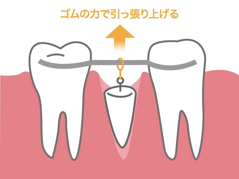 エキストリュージョン