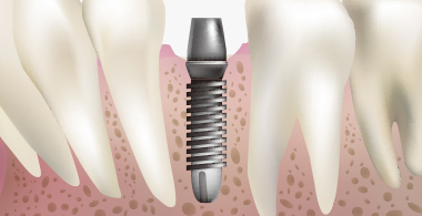 インプラント専門医が担当