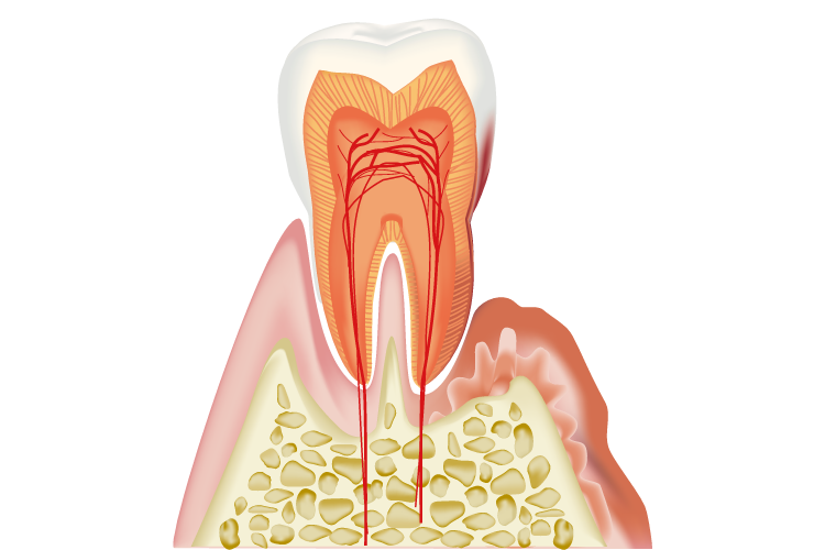 歯周病イメージ