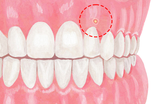 歯茎のできものの正体とは？原因と治療法を解説