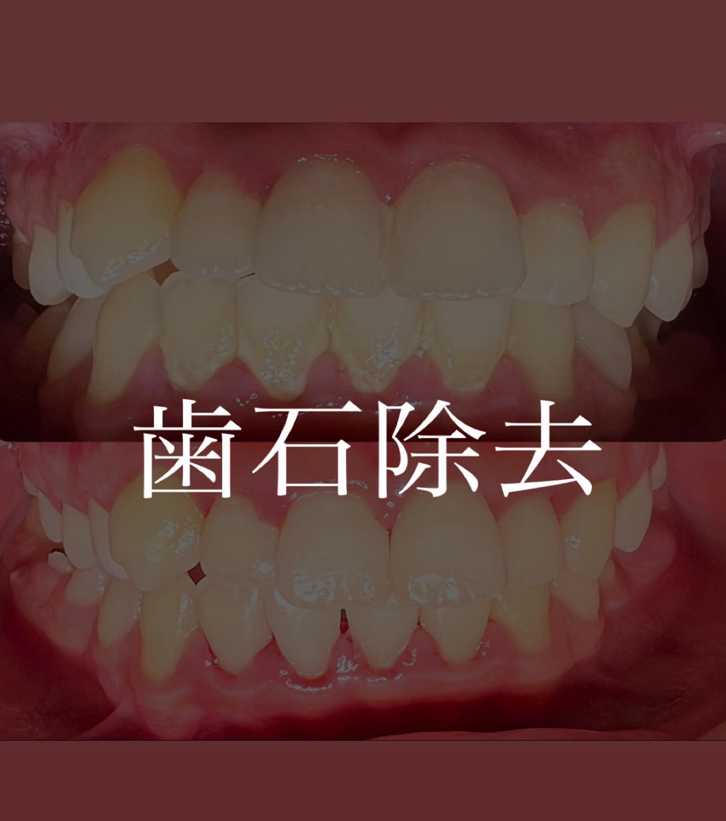 歯石除去のbefore→afterです🦷久しぶりのクリーニングとのことで歯石がたくさん着いていていました！歯茎も腫れているためここから１ヶ月後のチェックでどのくらい歯茎が良くなっているのか楽しみです人それぞれですが、だいたい定期検診で3-4ヶ月毎に歯石除去を行っています #歯石除去  #歯石  #クリーニング #歯周病予防  #歯周病  #歯肉炎 #高田馬場駅前デンタルクリニック #高田馬場  #歯医者 #駅近歯医者  #歯科医院 #デンタルクリニック #東京  #インプラント #矯正歯科  #口腔外科  #一般歯科 #審美歯科  #セラミック  #cleaning  #dental  #dentalhygiene  #dentalcleaning  #dentalphotography  #dentalclinic