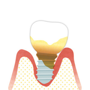 インプラントのトラブル