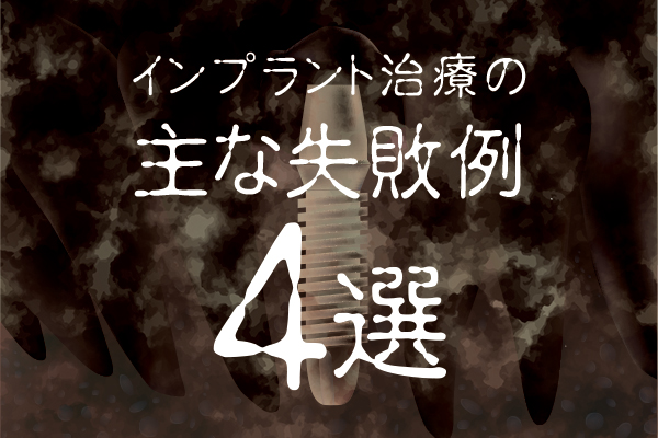 インプラント治療の主な失敗例4選：原因も併せて解説