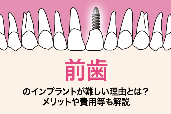 前歯のインプラントが難しい理由とは？メリットや費用等も解説