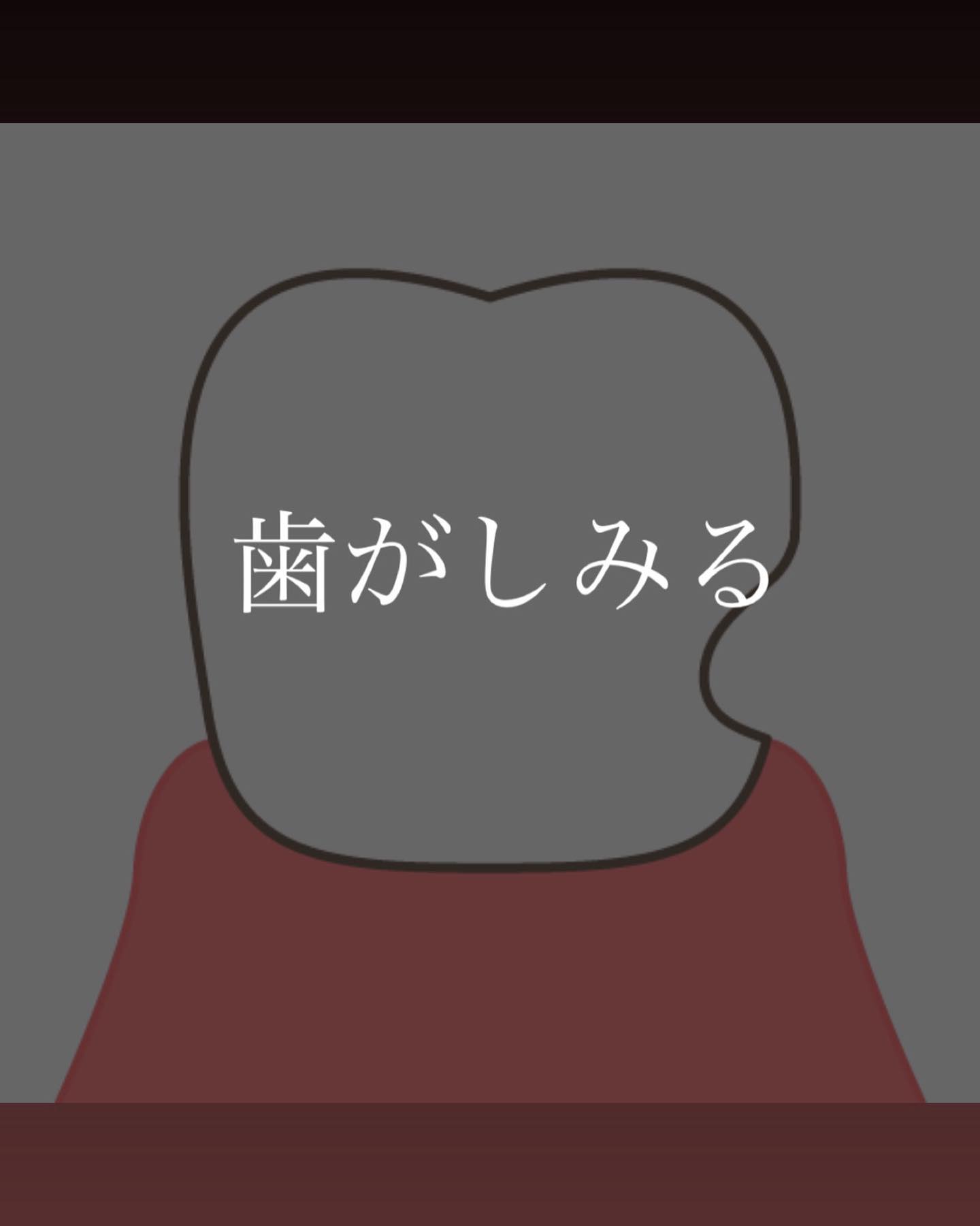 歯がしみる。そんなことありませんか？？例えば  冷たいお水を飲んだり  甘いものを食べたり  歯ブラシをしてる時に痛かったり歯がしみるのにも虫歯だけじゃなく、他の原因もあります。オーバーブラッシングについては歯科衛生士が適正なブラッシング圧の指導をさせていただきます🪥楔状欠損、咬耗、破折、脱離などは担当の先生がそれに合った治療法、対処療法を伝えさせていただきます🏻‍⚕️🦷いましみている、痛みが出ている、その他気になることがあれば是非担当の先生、歯科衛生士に聞いてください️ #高田馬場駅前デンタルクリニック #高田馬場  #歯医者 #駅近歯医者  #歯科医院 #デンタルクリニック #東京  #インプラント #矯正歯科  #口腔外科  #一般歯科 #審美歯科  #セラミック #知覚過敏  #歯がしみる