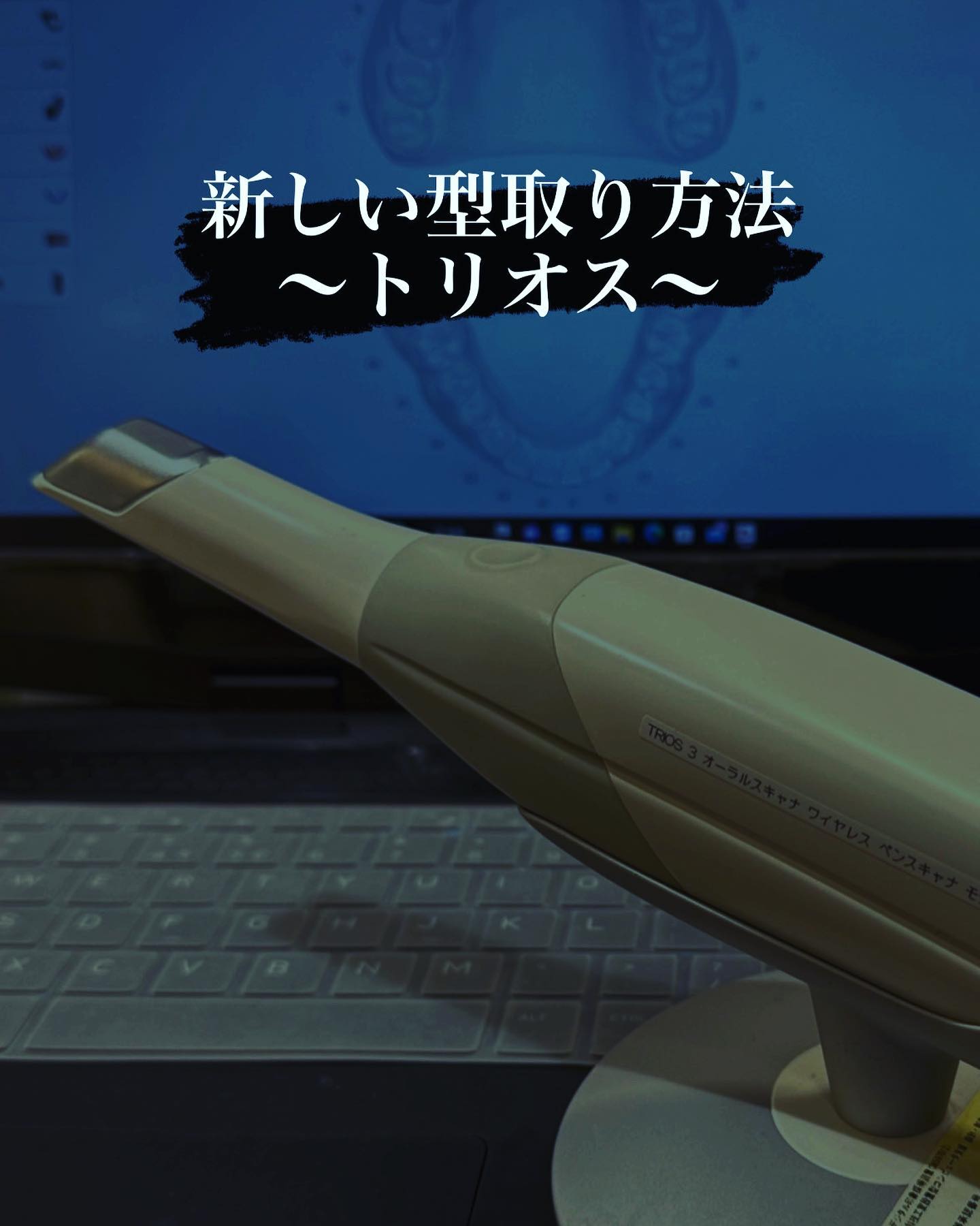 新しい歯の型取り法のご紹介です♪これまでは、ドロっとした粘土状の型取り材を使ってきました固まるまでの3分間、患者さんには息苦しさを我慢していただき、中には型取りが嫌で歯医者が嫌いになった方も多いのではないでしょうかデジタル技術が進歩して、ついに、型取り材を使わない型取りができるようになりました。3 shape 社のトリオスです️お口にスキャナーチップをあてることでスムーズに型取りが進みますその時間、なんと！たったの34秒！！歯をぐるっと全周見れるのも良いですよね型取りの正確性が高いことも実証されてきています型取りが苦手な方はぜひ当院のトリオスを使ってみてはいかがでしょうか🦷