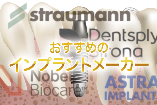 おすすめのインプラントメーカーを紹介：メーカーの選び方等も解説