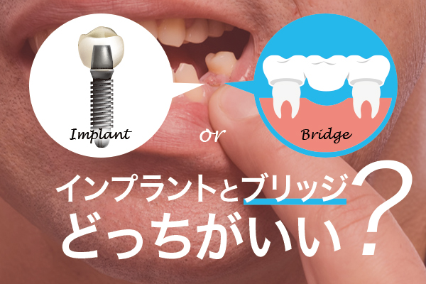 インプラントかブリッジかどっちがいい？徹底比較とおすすめの人を解説