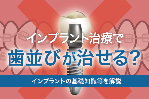 インプラント治療で歯並びが悪いのは治せる？インプラントの基礎知識等を解説