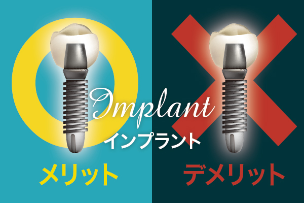 インプラントのメリットとデメリットとは？それぞれ解説