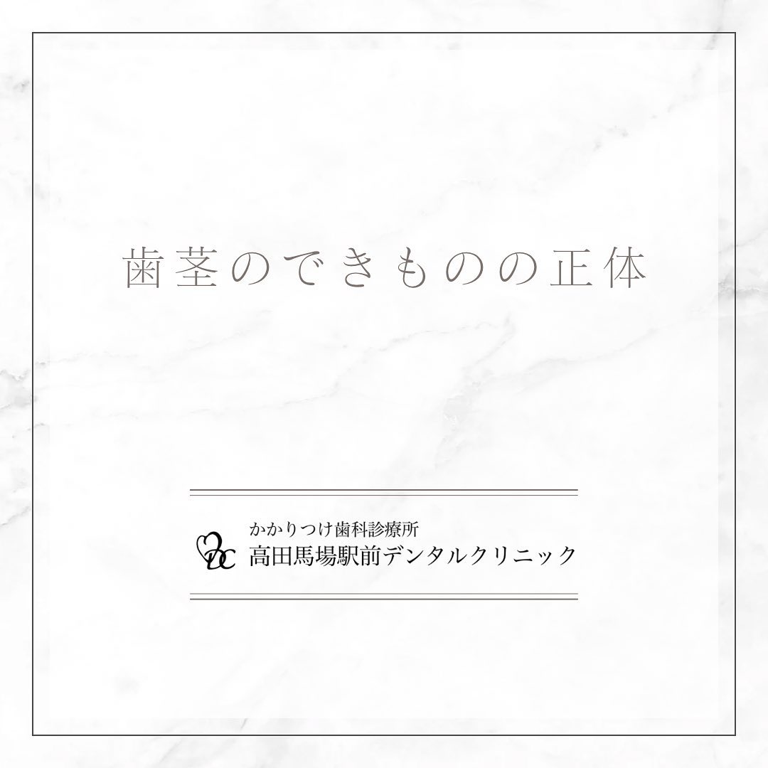 こんにちは！高田馬場駅前デンタルクリニックです🦷🦷 歯茎のできものが気になる️口内炎か膿の出口（サイナストラクト、フィステルなどと呼びます）か、原因について解説します。放置はNG！早めの治療が大切です。お問い合わせやご予約はお気軽にどうぞ️高田馬場駅前デンタルクリニック〒169-0075東京都新宿区高田馬場2丁目16-2 1F03-6380-2467#高田馬場 #歯医者 #高田馬場歯医者 #インプラント #虫歯 #審美歯科 #デンタルクリニック #一般歯科 #矯正歯科 #口腔外科 #PMTC #ホワイトニング #エアフロー #歯の健康 #口内炎 #フィステル #サイナストラクト