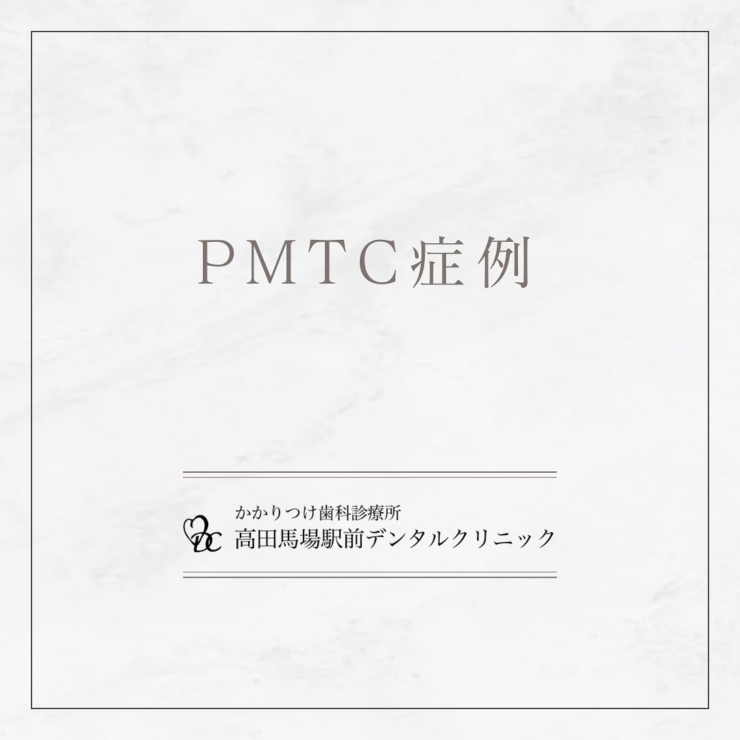こんにちは!高田馬場駅前デンタルクリニックです🦷今日はPMTC(プロフェッショナル・メカニカル・ティース・クリーニング)の効果をご紹介します。PMTCは様々なブラシや研磨剤などを用いて、歯の表面や歯茎の間の歯垢や着色を徹底的に除去し、口内環境を健康に整えます。日常の歯磨きでは取り切れない歯石やステインも除去!白く輝く歯と清潔な口内で、自信に満ちた笑顔を手に入れましょう!お問い合わせやご予約はお気軽にどうぞ️高田馬場駅前デンタルクリニック〒169-0075東京都新宿区高田馬場2丁目16-2 1F03-6380-2467#高田馬場 #歯医者 #高田馬場歯医者 #インプラント #虫歯 #審美歯科 #デンタルクリニック #一般歯科 #矯正歯科 #口腔外科 #PMTC #ホワイトニング #エアフロー #セラミッククラウン
