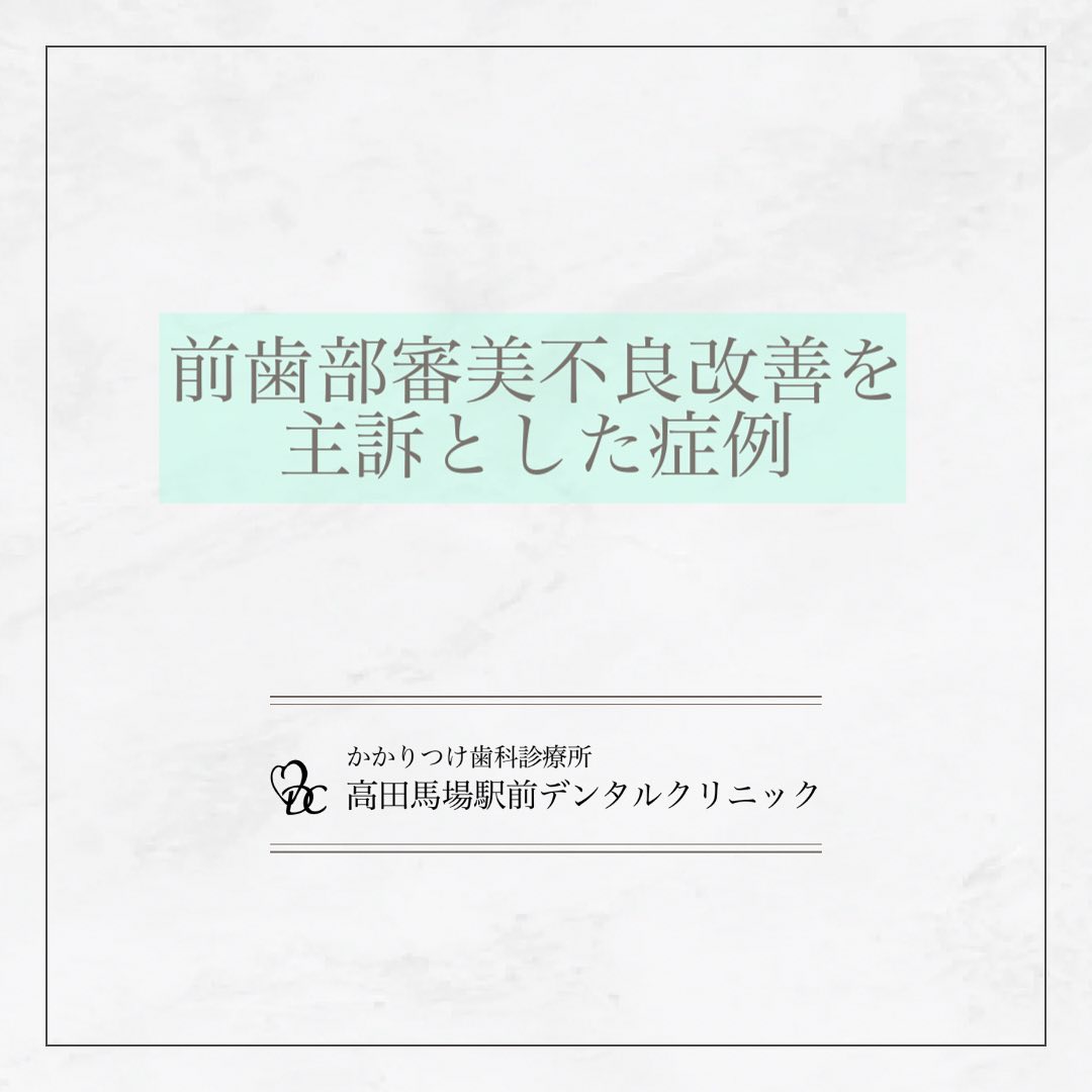 こんにちは！高田馬場駅前デンタルクリニックです。 新しい笑顔の誕生 インプラント治療後、審美不良を訴えて来院された患者様。歯茎の移植により、見た目が劇的に改善されました！患者様からは「満足する見た目になれて感謝しています」とのお言葉をいただきました。患者様の笑顔を引き立てるお手伝いができて嬉しいです！お問い合わせやご予約はお気軽にどうぞ️高田馬場駅前デンタルクリニック〒169-0075東京都新宿区高田馬場2丁目16-2 1F03-6380-2467#高田馬場 #歯医者 #高田馬場歯医者 #インプラント #虫歯 #審美歯科 #デンタルクリニック #一般歯科 #矯正歯科 #口腔外科 #PMTC #ホワイトニング #審美不良