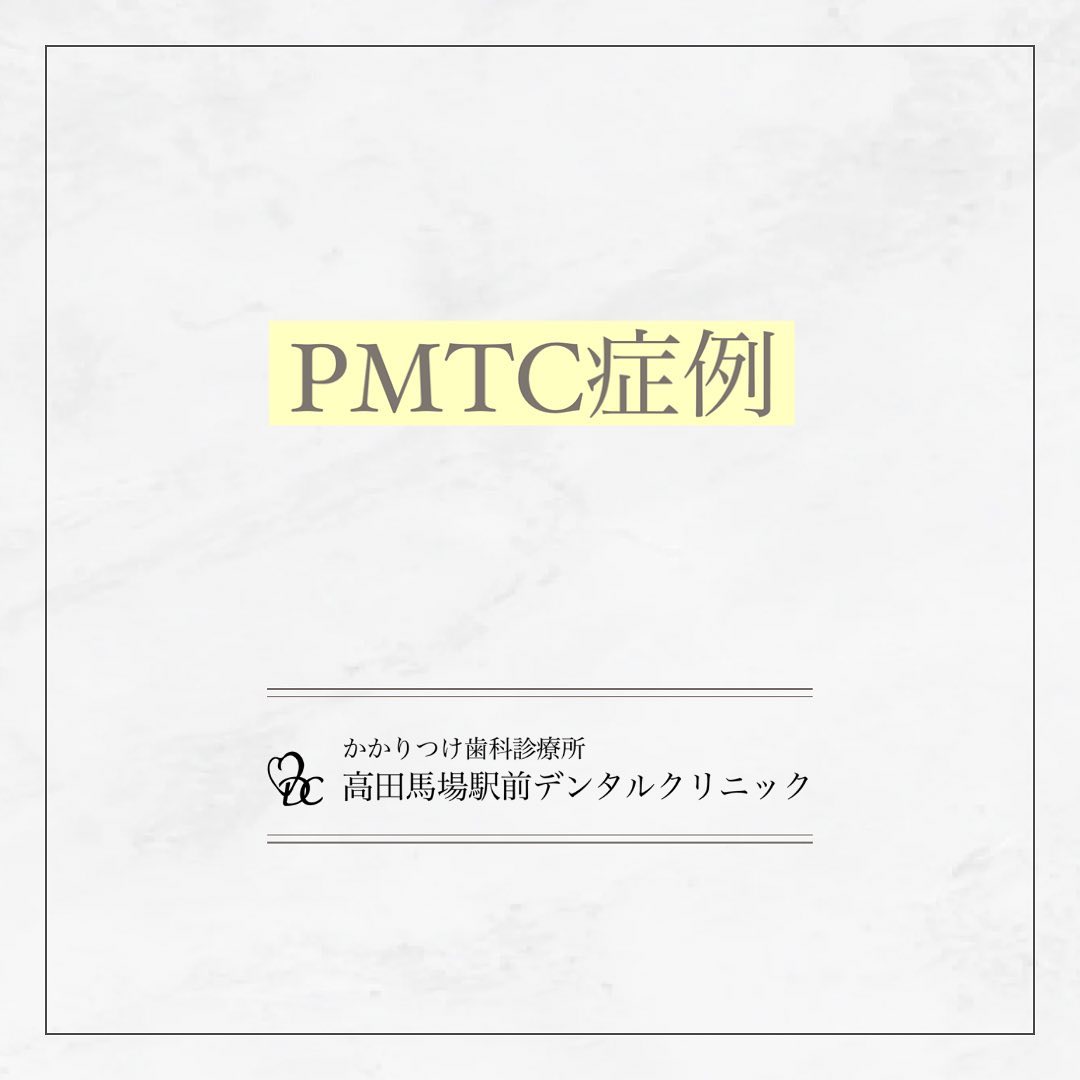 こんにちは！高田馬場駅前デンタルクリニックです。 PMTC症例報告 今回は、PMTC（プロフェッショナル・メカニカル・ティース・クリーニング）の症例をご紹介します！PMTCは専門家による丁寧な歯のクリーニングで、歯垢や歯石を除去し、口腔内の清潔を保ちます。日常の歯磨きでは取り切れない歯石やステインも除去！白く輝く歯と清潔な口内で、自信に満ちた笑顔を手に入れましょう！お問い合わせやご予約はお気軽にどうぞ️高田馬場駅前デンタルクリニック〒169-0075東京都新宿区高田馬場2丁目16-2 1F03-6380-2467#高田馬場 #歯医者 #高田馬場歯医者 #インプラント #虫歯 #審美歯科 #デンタルクリニック #一般歯科 #矯正歯科 #口腔外科 #PMTC #ホワイトニング